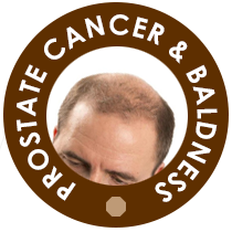 Prostate cancer is linked with Baldness